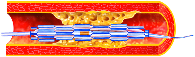 Fig4: Le stent replié sur lui-même, monté sur le cathéter à ballonnet, coulisse sur un fin mandrin métallique jusqu'au niveau du rétrécissement de l'artère coronaire