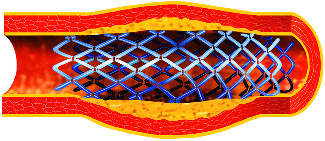 Fig6: Après vidange du ballonnet, on retire cathéter et mandrin. La pose réussie d'un stent permet à nouveau un écoulement normal du sang