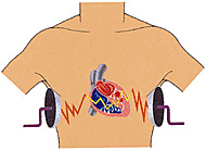 Defibrillatore L’impulso di corrente elettrica emesso dagli elettrodi può rinormalizzare l’attività cardiaca.