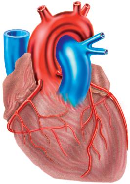 Malattia coronarica Depositi arteriosclerotici nelle coronarie causano un’insufficiente irrorazione sanguigna del miocardio.